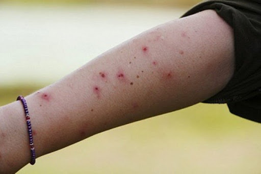 Làm thế nào để giảm ngứa vết muỗi đốt nhanh chóng