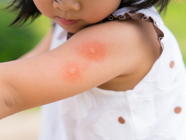 Các biện pháp xua đuổi muỗi tại nhà và cách làm dịu vết đốt của muỗi